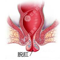 脱肛科普图片，这个无压力