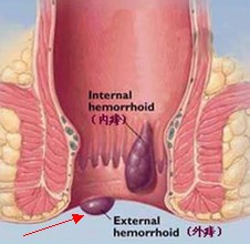 外痔疮图片