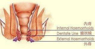 混合痔图片
