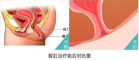 脱肛治疗前后