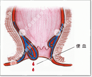 大便出血不疼不痒怎么回事？