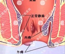 福州治痔疮的手术费用是多少