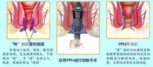 便血两天第三天就没有了