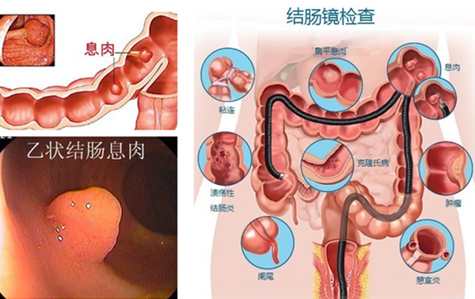 突然大量便血暗红