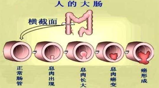 肠癌每天都便血吗