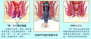 便血可自愈吗