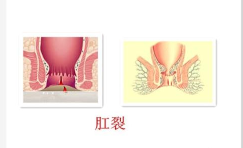 治疗肛裂的方法有哪些