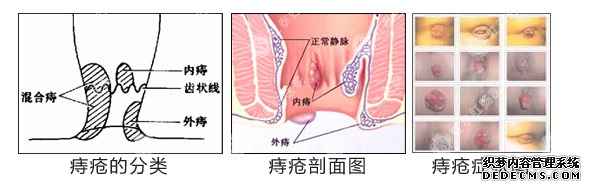 福州肛肠医院 福州医博肛肠医院 福州看痔疮的医院 福州肛瘘医院 福州肛裂医院 福州肠炎医院