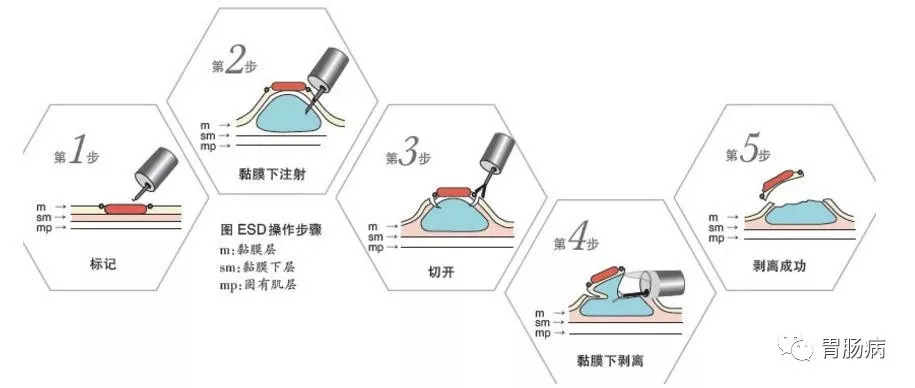 做完痔疮手术多久恢复