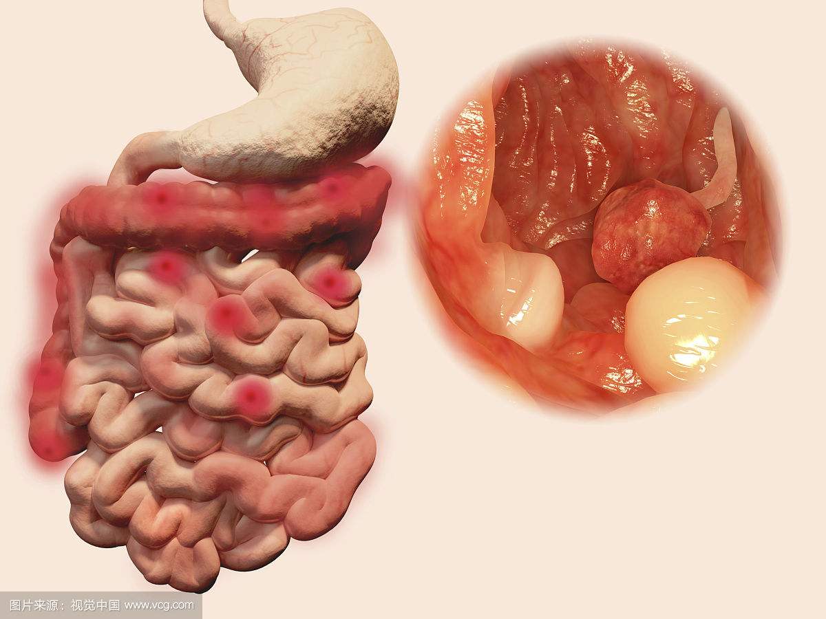 恼人的孕期痔疮，如何预防治疗？