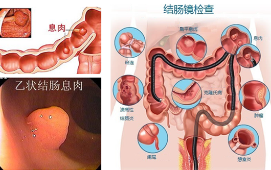 痔疮为什么会痒