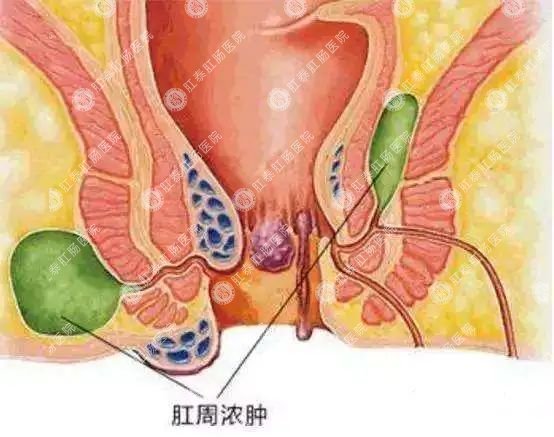 福州治肛门异物哪家医院好些